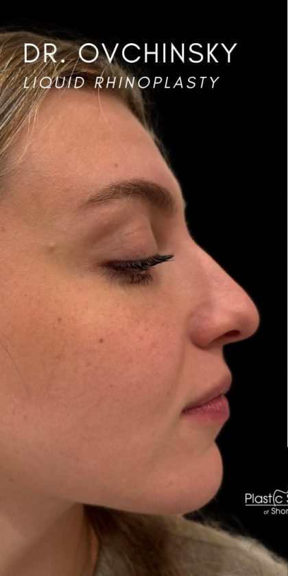 Liquid Rhinoplasty(Non-Surgical) Before & After Patient #18907