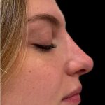 Liquid Rhinoplasty(Non-Surgical) Before & After Patient #18907