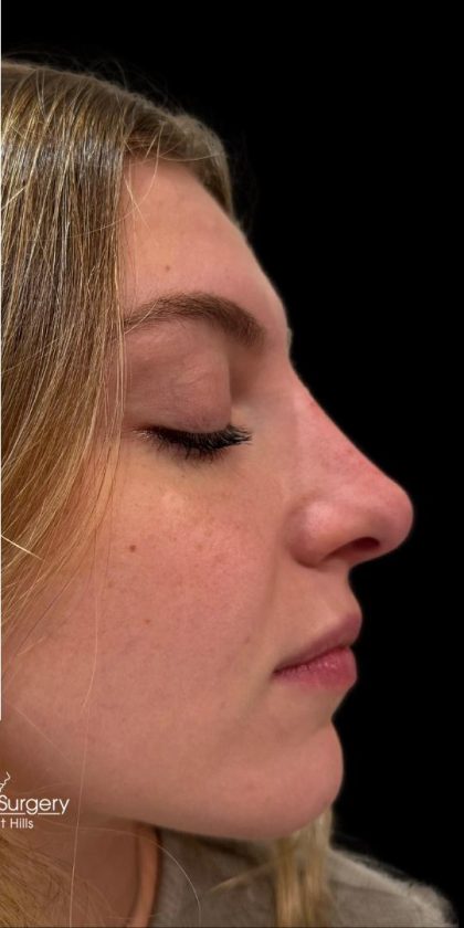 Liquid Rhinoplasty(Non-Surgical) Before & After Patient #18907