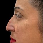Liquid Rhinoplasty(Non-Surgical) Before & After Patient #18908