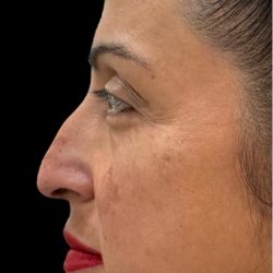 Liquid Rhinoplasty(Non-Surgical) Before & After Patient #18908