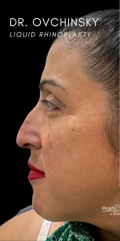 Liquid Rhinoplasty(Non-Surgical) Before & After Patient #18908