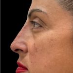 Liquid Rhinoplasty(Non-Surgical) Before & After Patient #18908