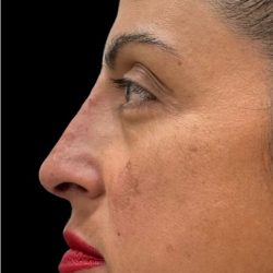 Liquid Rhinoplasty(Non-Surgical) Before & After Patient #18908