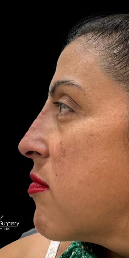 Liquid Rhinoplasty(Non-Surgical) Before & After Patient #18908