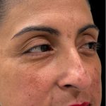 Liquid Rhinoplasty(Non-Surgical) Before & After Patient #18908