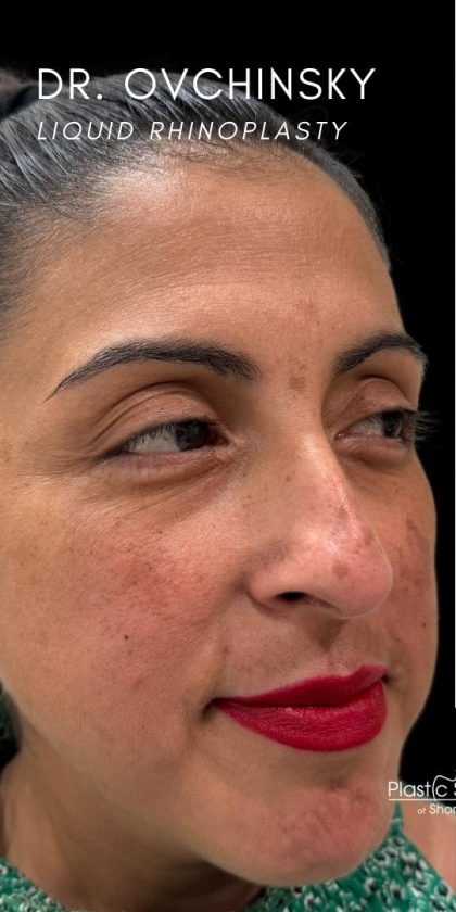 Liquid Rhinoplasty(Non-Surgical) Before & After Patient #18908