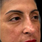 Liquid Rhinoplasty(Non-Surgical) Before & After Patient #18908