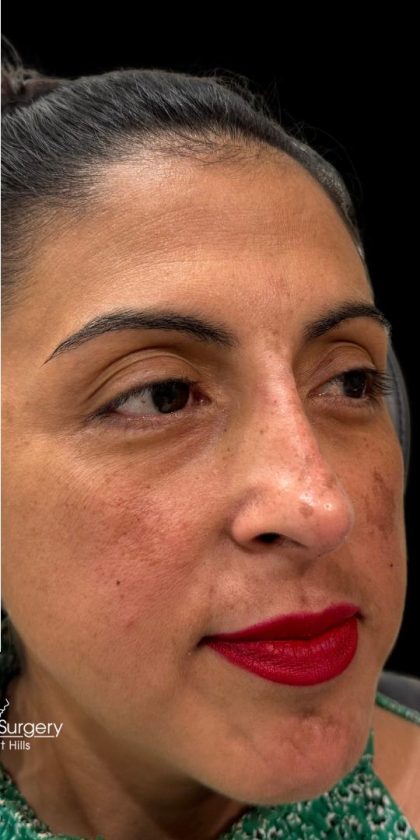 Liquid Rhinoplasty(Non-Surgical) Before & After Patient #18908