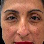 Liquid Rhinoplasty(Non-Surgical) Before & After Patient #18908