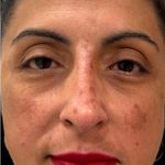 Liquid Rhinoplasty(Non-Surgical) Before & After Patient #18908
