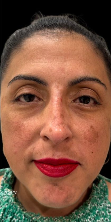 Liquid Rhinoplasty(Non-Surgical) Before & After Patient #18908