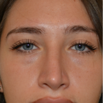 Revision Rhinoplasty Before & After Patient #18920