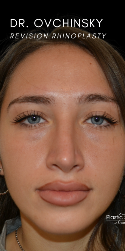 Revision Rhinoplasty Before & After Patient #18920