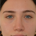 Revision Rhinoplasty Before & After Patient #18920