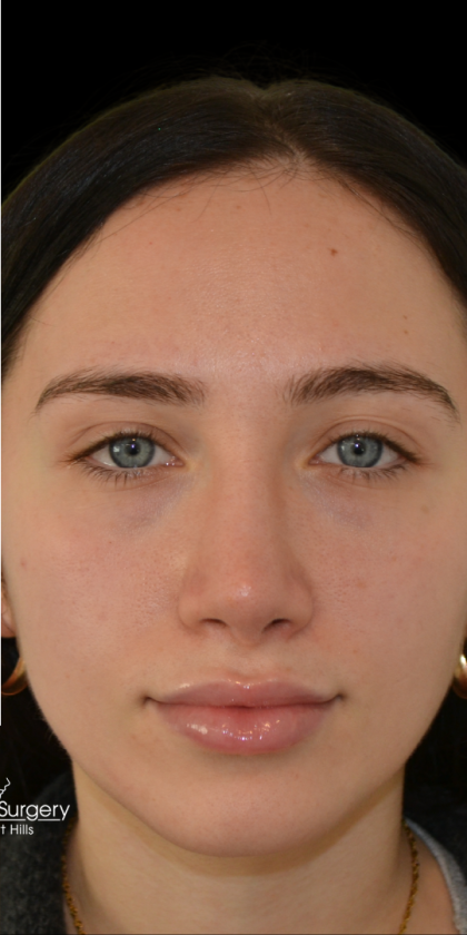 Revision Rhinoplasty Before & After Patient #18920