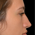 Revision Rhinoplasty Before & After Patient #18920