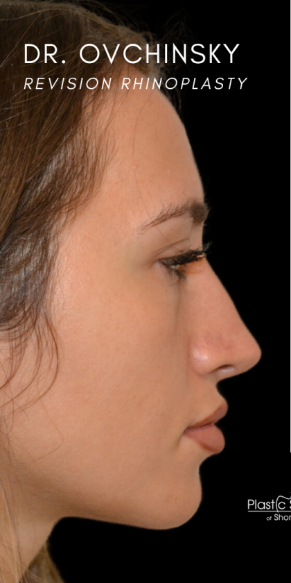 Revision Rhinoplasty Before & After Patient #18920