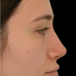 Revision Rhinoplasty Before & After Patient #18920