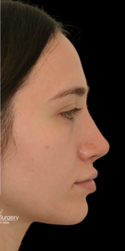 Revision Rhinoplasty Before & After Patient #18920