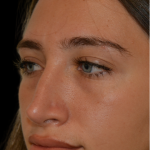 Revision Rhinoplasty Before & After Patient #18920