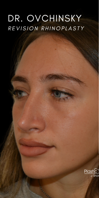 Revision Rhinoplasty Before & After Patient #18920