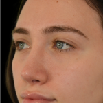Revision Rhinoplasty Before & After Patient #18920