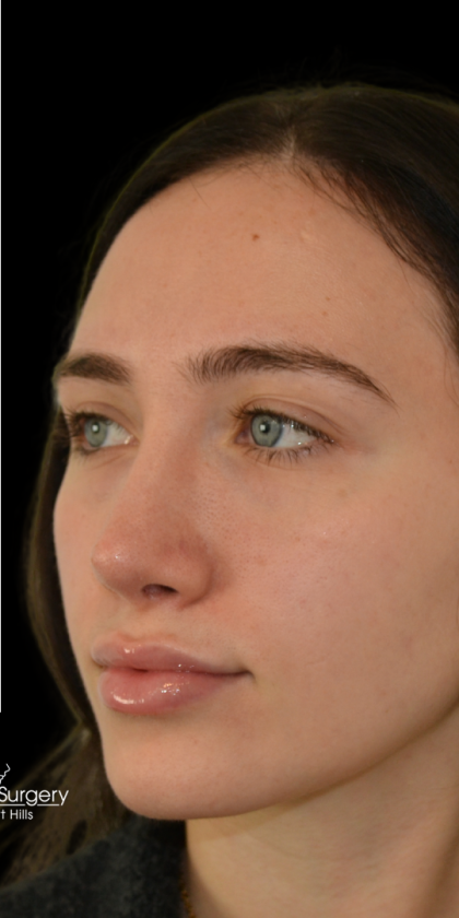 Revision Rhinoplasty Before & After Patient #18920