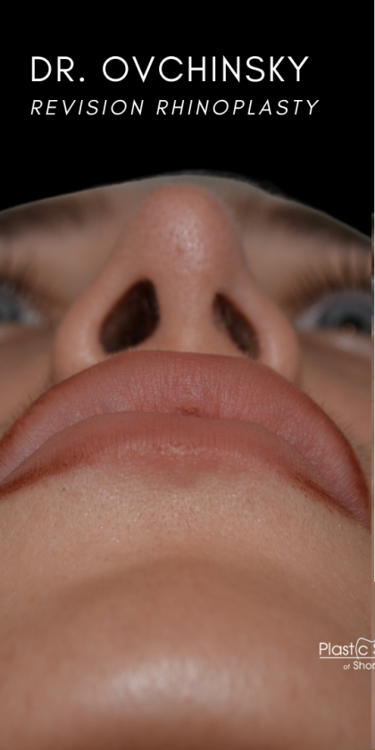Revision Rhinoplasty Before & After Patient #18920