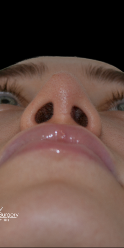 Revision Rhinoplasty Before & After Patient #18920