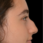 Rhinoplasty Before & After Patient #18919