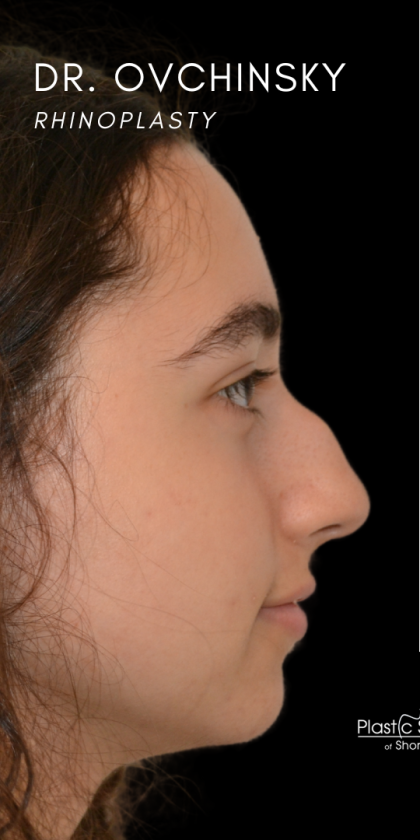 Rhinoplasty Before & After Patient #18919