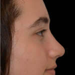 Rhinoplasty Before & After Patient #18919