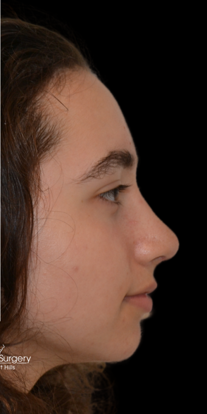 Rhinoplasty Before & After Patient #18919