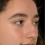 Rhinoplasty Before & After Patient #18919