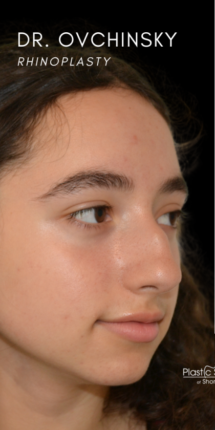 Rhinoplasty Before & After Patient #18919