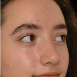 Rhinoplasty Before & After Patient #18919
