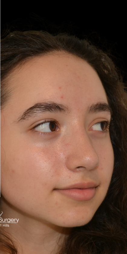 Rhinoplasty Before & After Patient #18919
