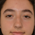 Rhinoplasty Before & After Patient #18919