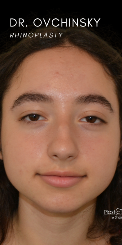 Rhinoplasty Before & After Patient #18919