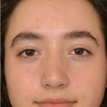 Rhinoplasty Before & After Patient #18919