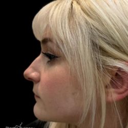Liquid Rhinoplasty(Non-Surgical) Before & After Patient #19227