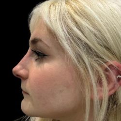 Liquid Rhinoplasty(Non-Surgical) Before & After Patient #19227