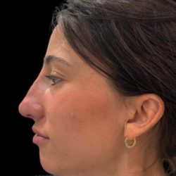 Liquid Rhinoplasty(Non-Surgical) Before & After Patient #19229