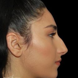 Rhinoplasty Before & After Patient #19280