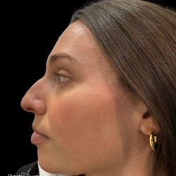 Liquid Rhinoplasty(Non-Surgical) Before & After Patient #19336