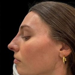 Liquid Rhinoplasty(Non-Surgical) Before & After Patient #19336