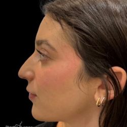 Liquid Rhinoplasty(Non-Surgical) Before & After Patient #19317