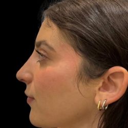 Liquid Rhinoplasty(Non-Surgical) Before & After Patient #19317
