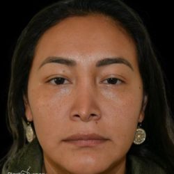 Revision Rhinoplasty Before & After Patient #19349